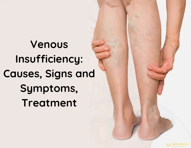Venous Insufficiency: Causes, Signs, Symptoms and Treatment - Elite Vascular