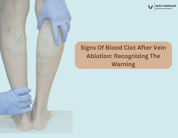 Signs Of Blood Clot After Vein Ablation