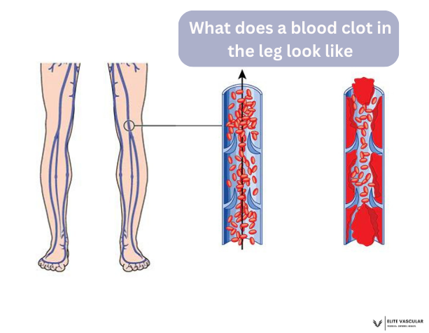 What does a blood clot in the leg look like