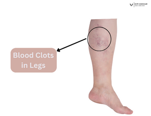blood clots in legs pictures