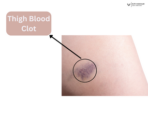 thigh blood clot pictures