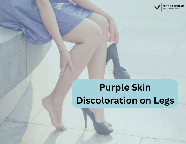 Purple Skin Discoloration on Legs