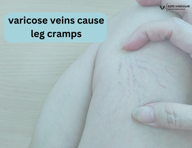 varicose veins cause leg cramps