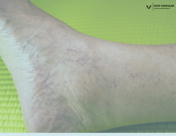 varicose veins around ankles