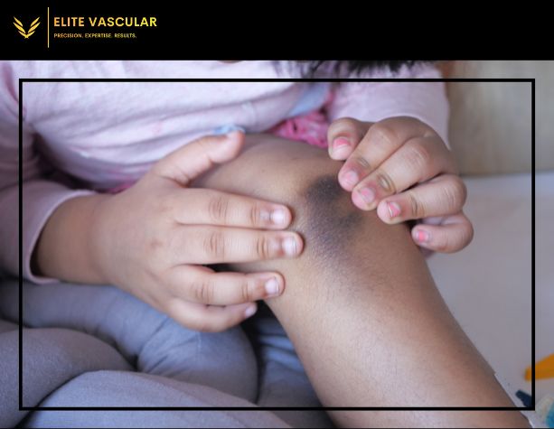 Bruises Vs. Varicose Veins: Understanding The Key Differences