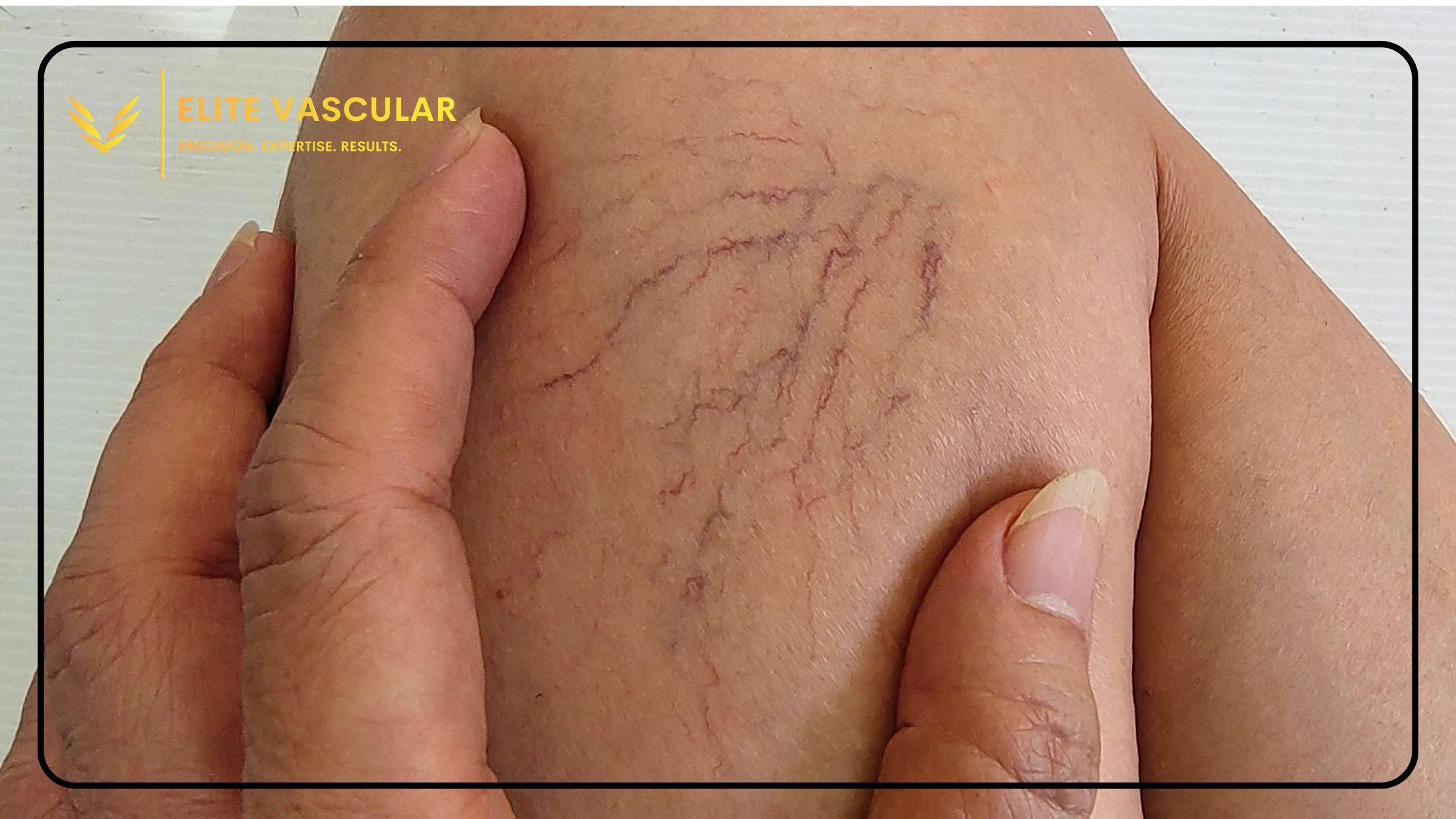 Cutting-Edge Treatments for Reticular Veins What's New