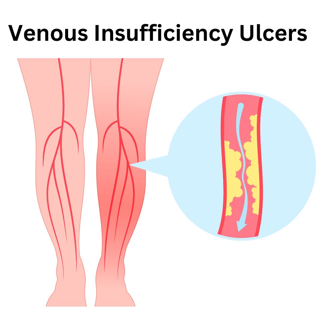 Venous Insufficiency Ulcers