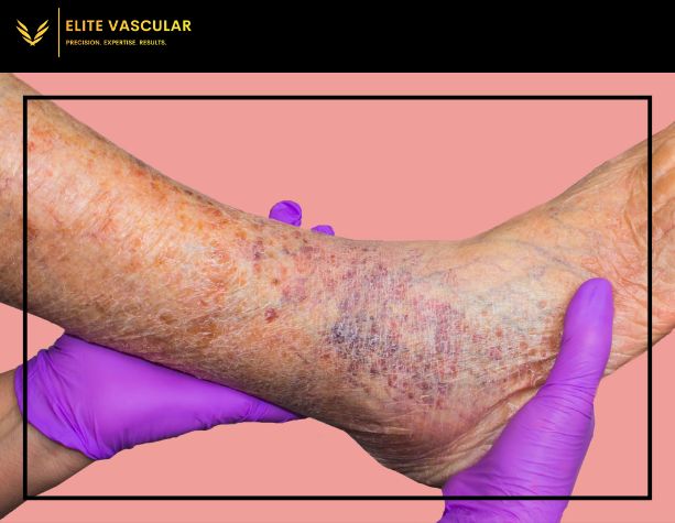 When to See a Vein Specialist: Signs and Symptoms to Watch For