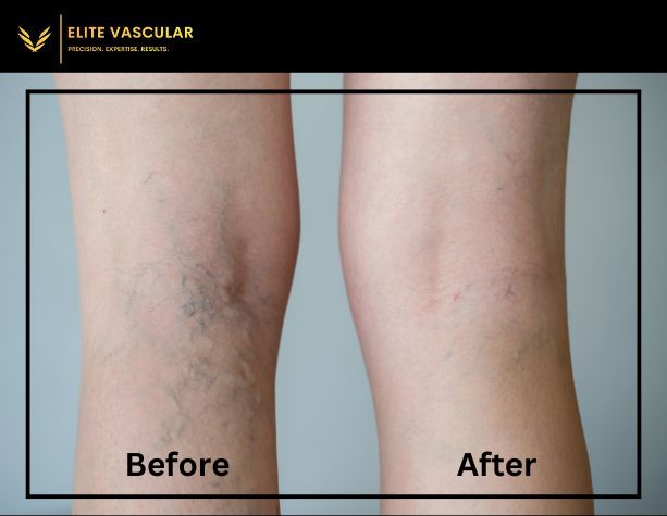 Life-Changing Before And After Spider Vein Removal