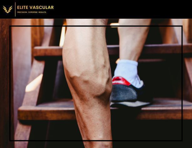 what causes varicose veins