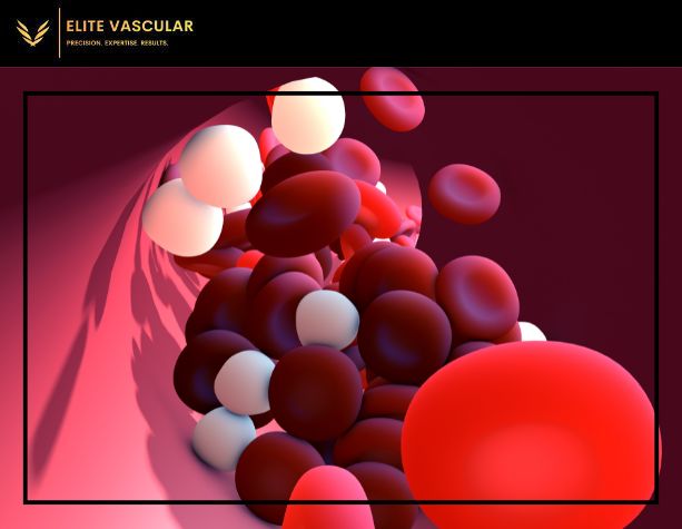 Blood Clot Detection After Vein Ablation