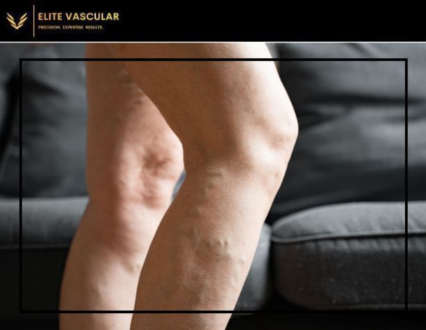 can varicose veins be hard lumps