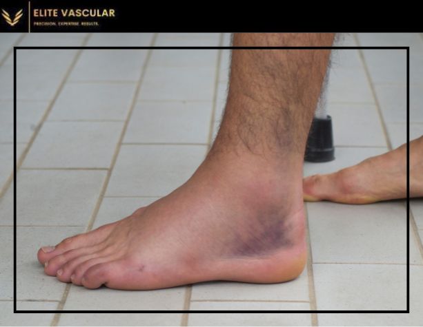 ankle discoloration