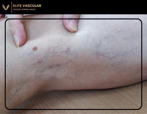 How to Recognize and Prevent Deep Vein Thrombosis (DVT)