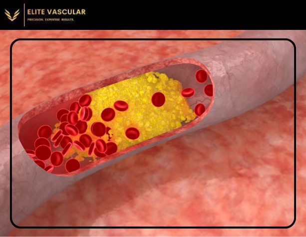 What is Peripheral Artery Disease (PAD) and How Can It Be Treated