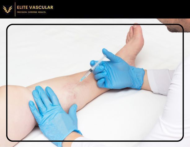 Which is Better for Vein Treatment_ Varithena or Sclerotherapy