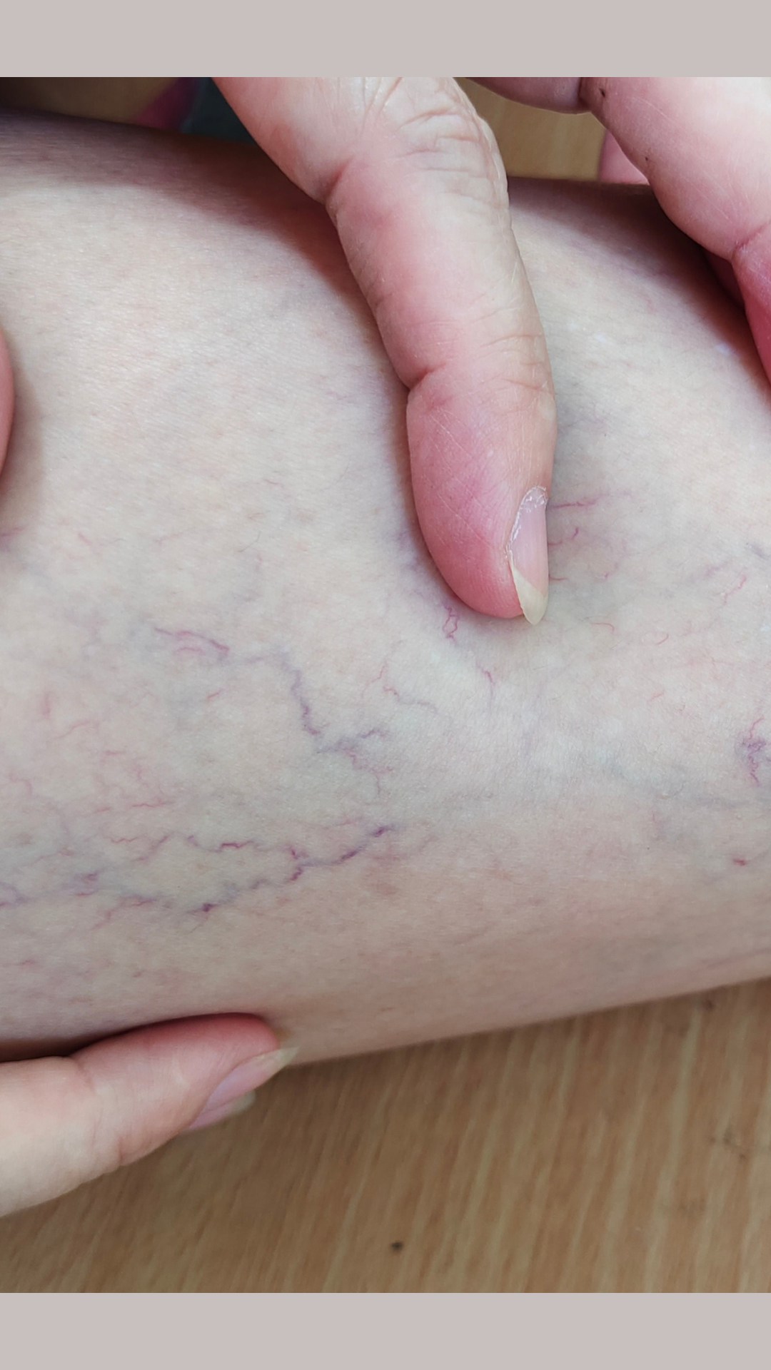 spider vein removal near me