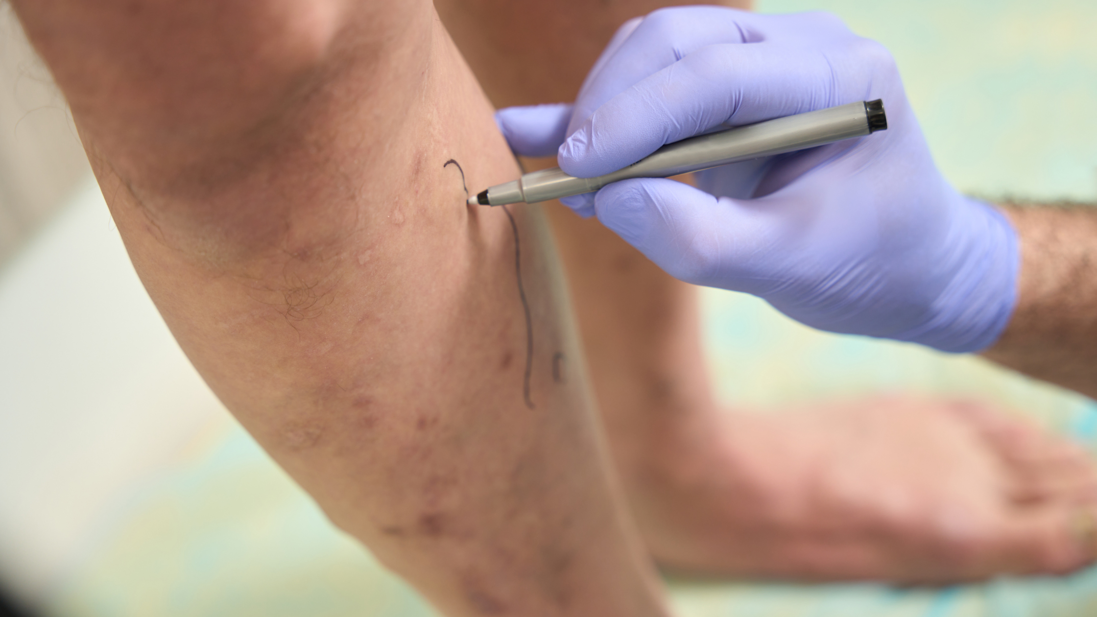 sclerotherapy near me