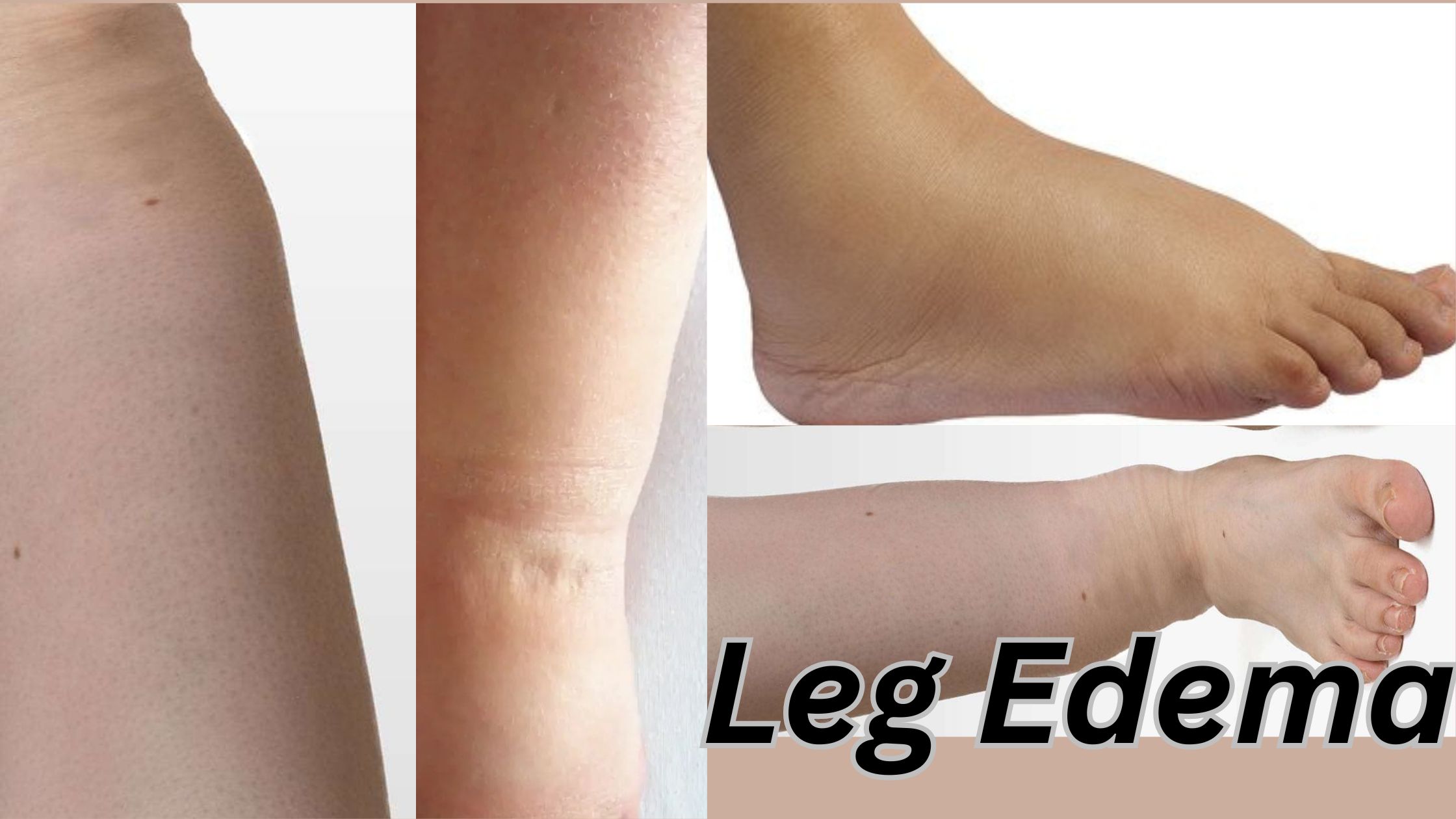Left Leg Edema