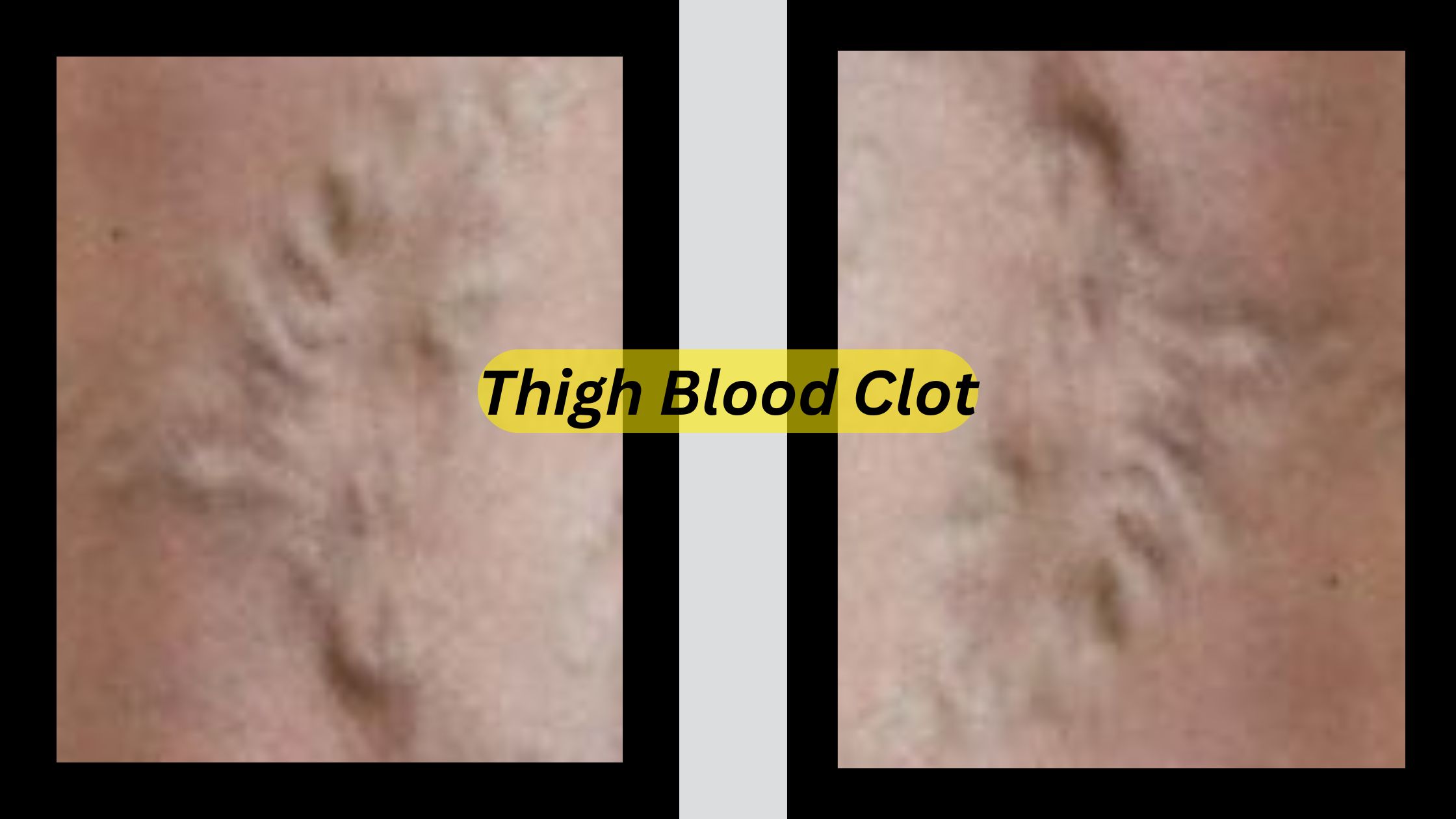 Can inner thigh pain be a blood clot