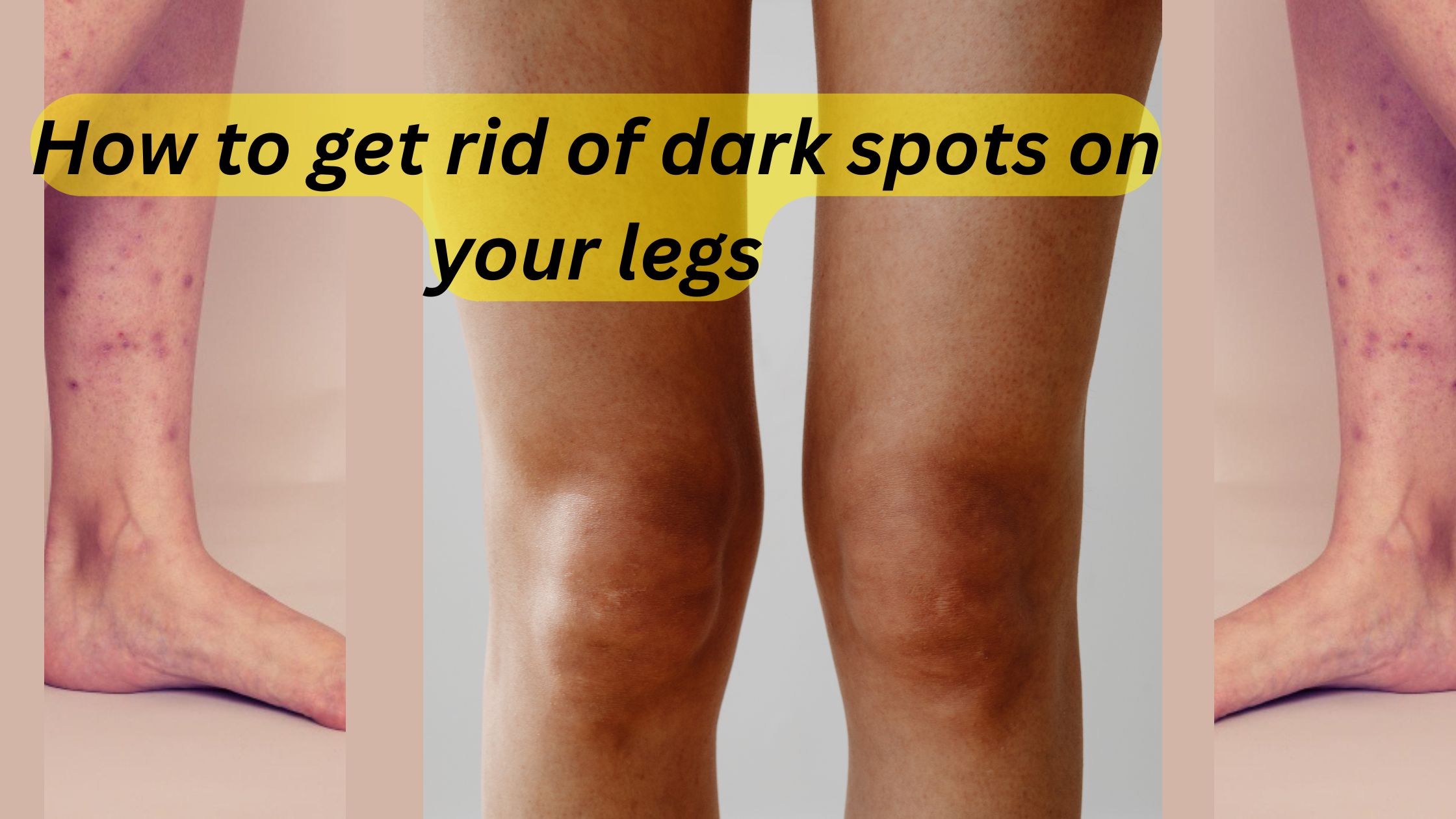 How to Get Rid of Dark Spots on Your Legs