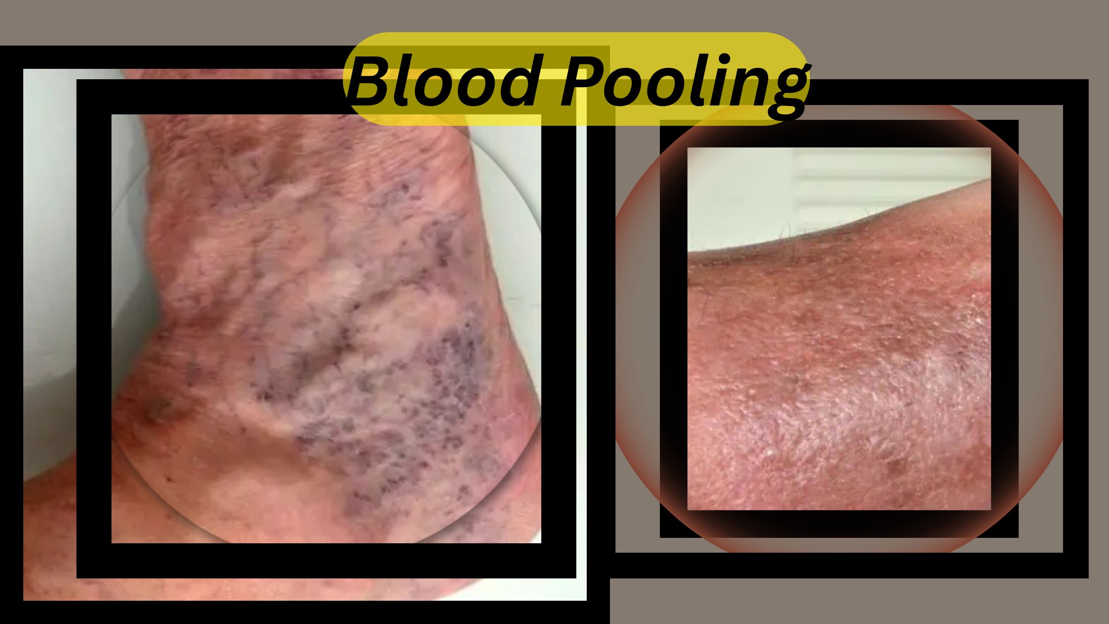 Is Blood Pooling Dangerous