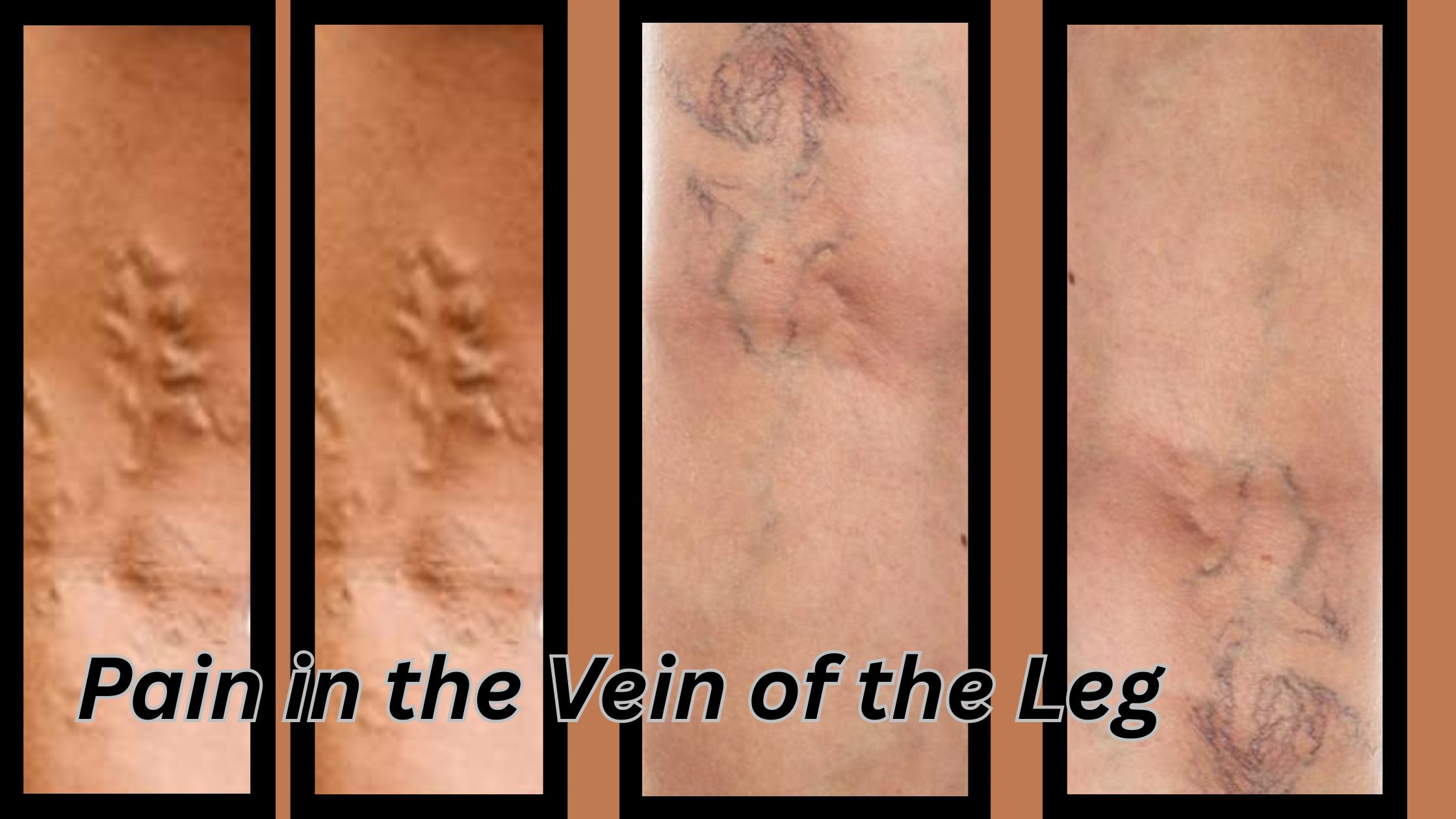 Pain in the Vein of the Leg