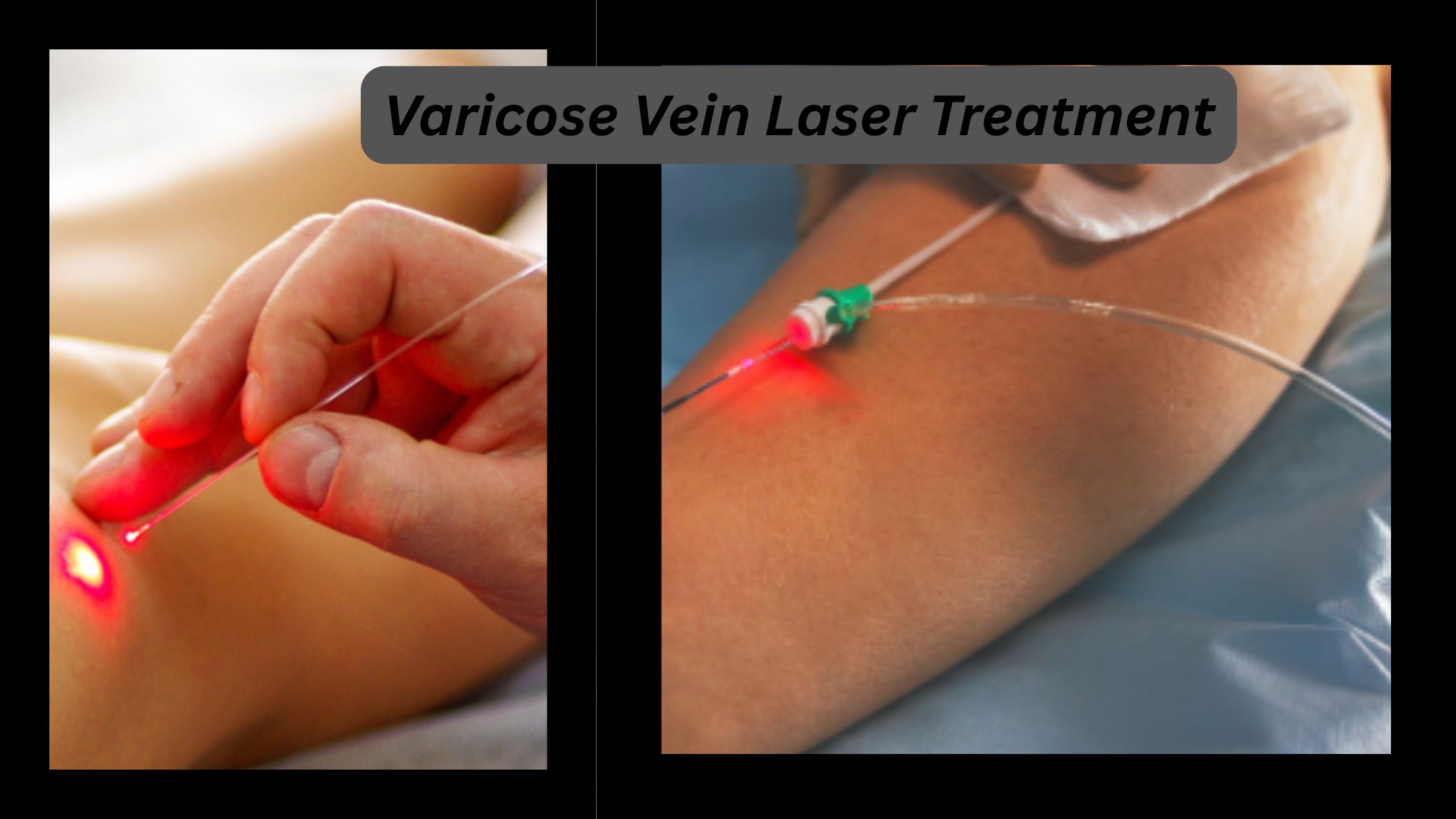 Varicose Vein Laser Treatment