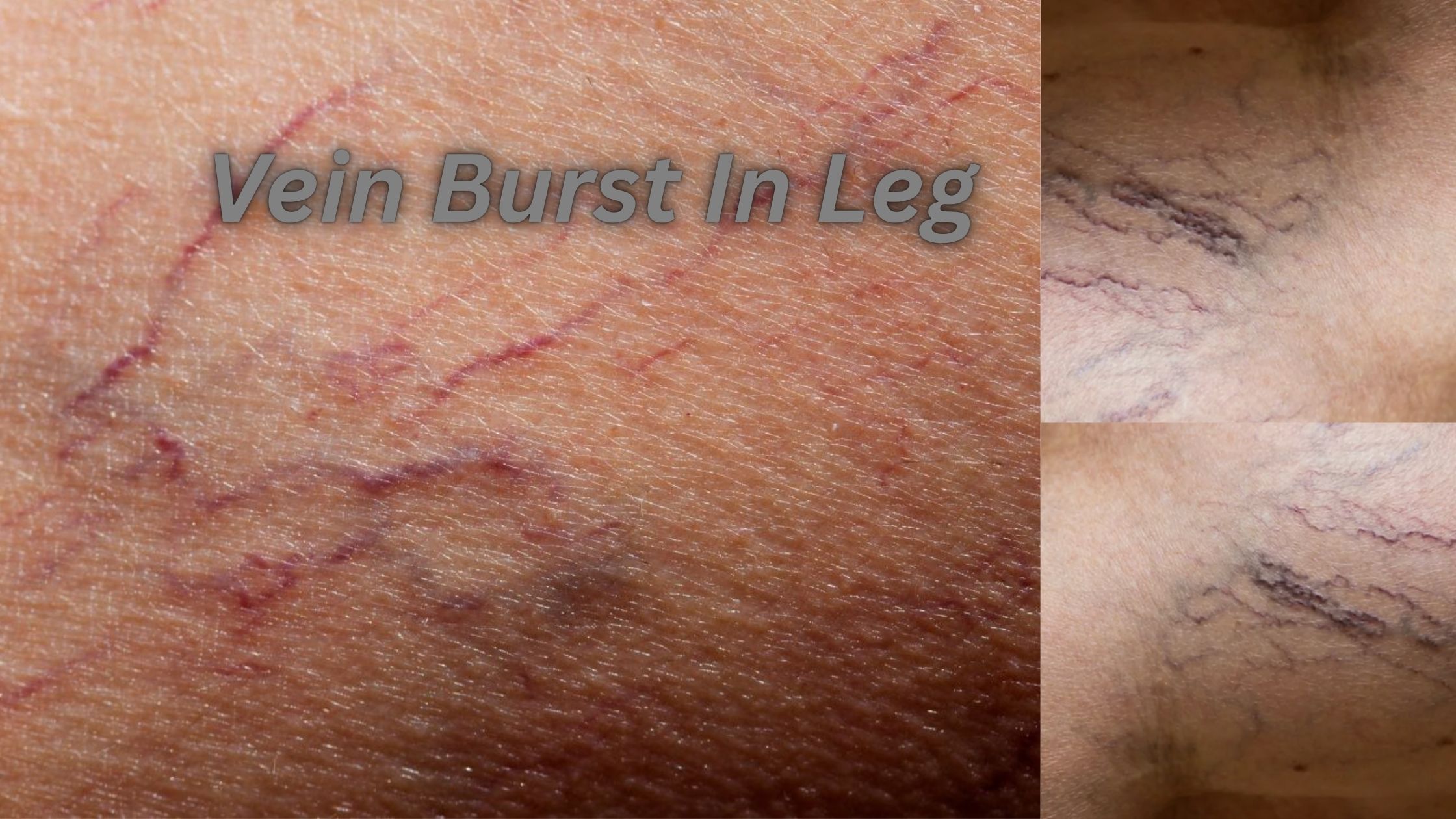 Vein burst in leg