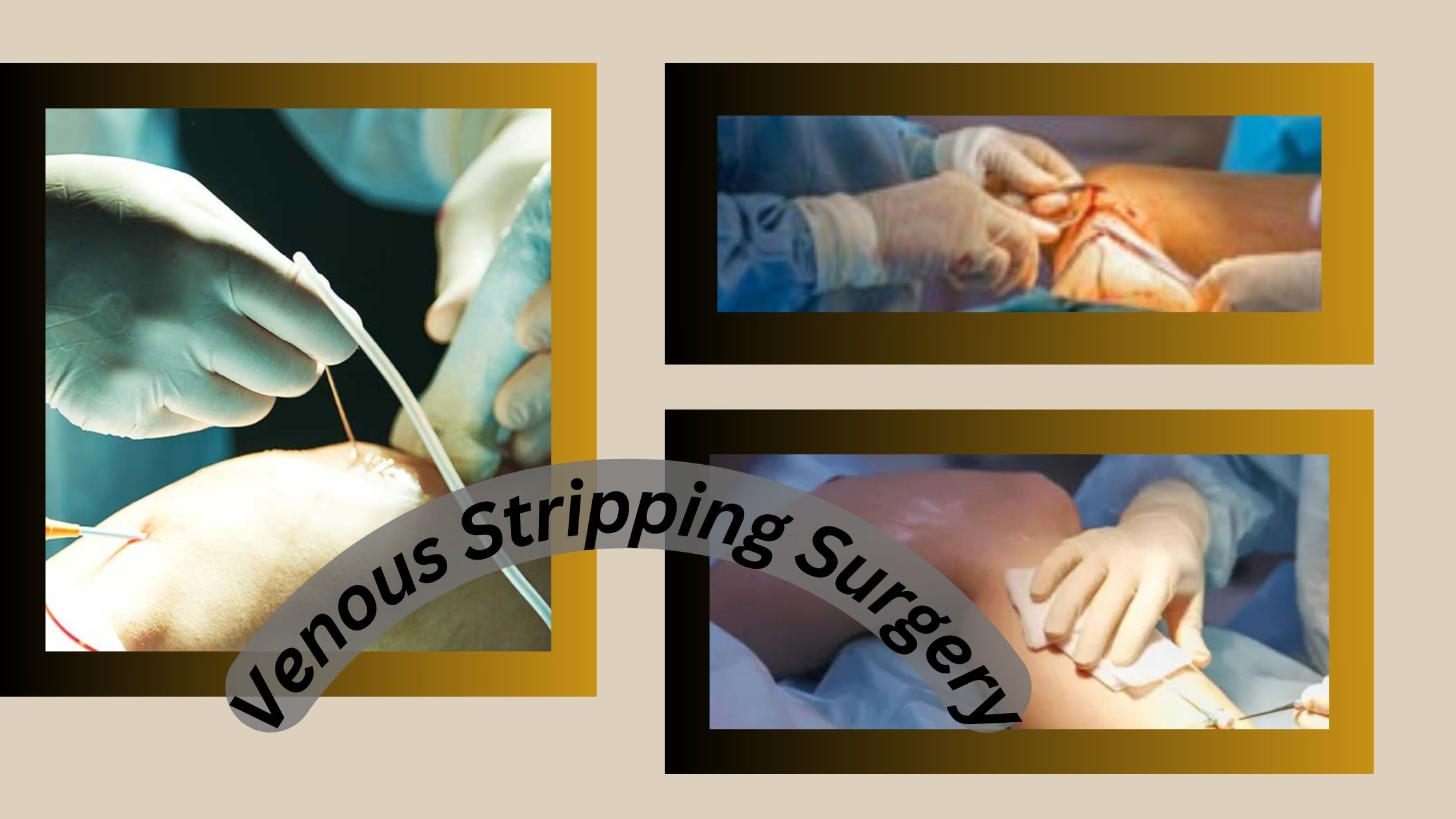 Venous Stripping Surgery