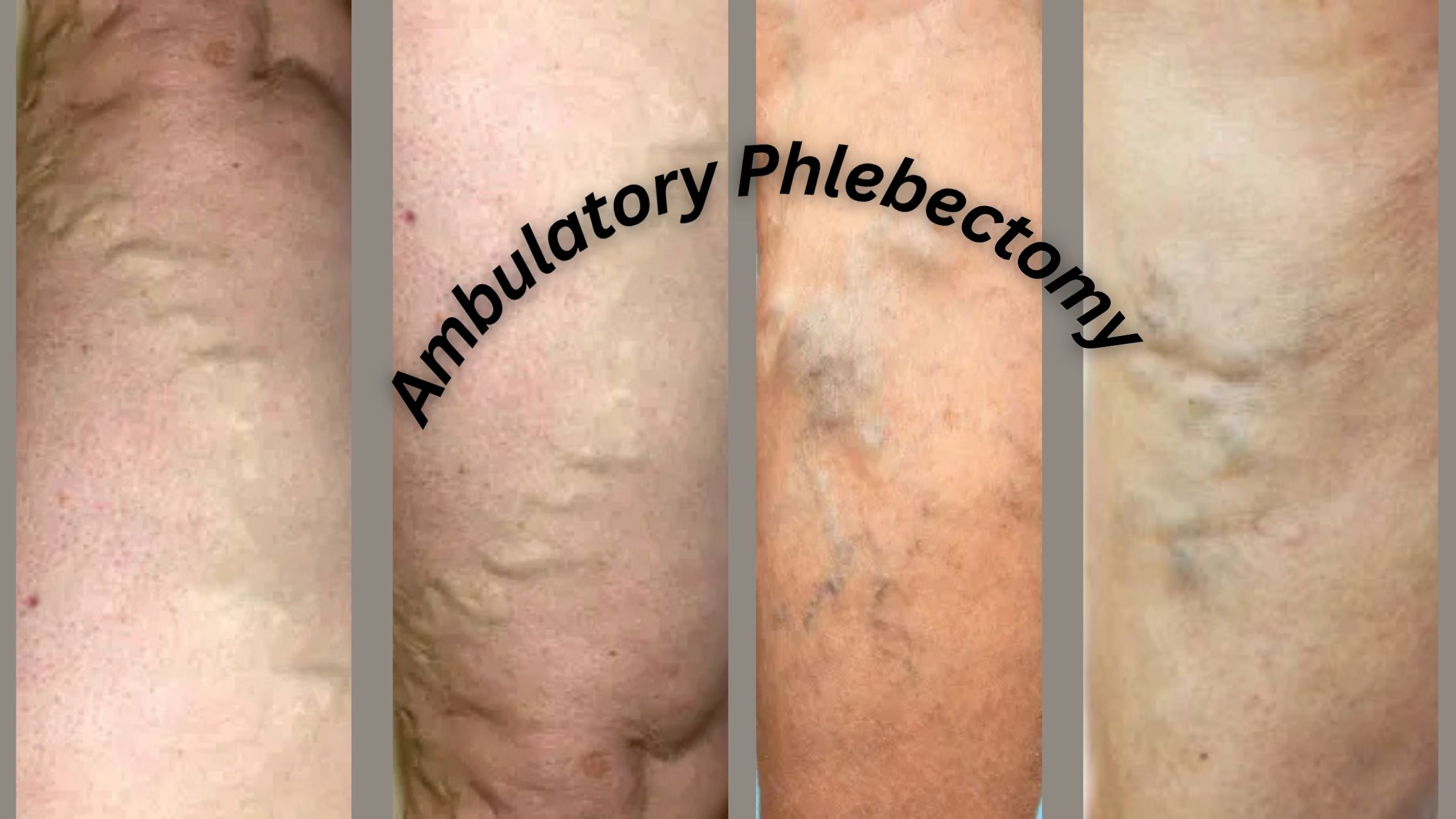 Ambulatory Phlebectomy