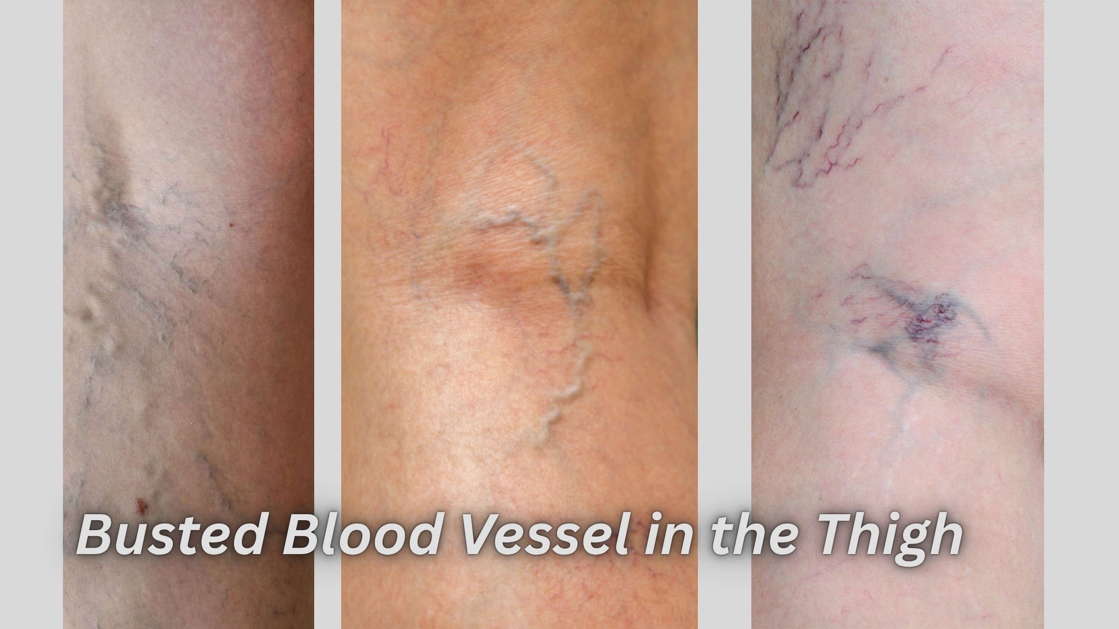 Busted Blood Vessel in the Thigh