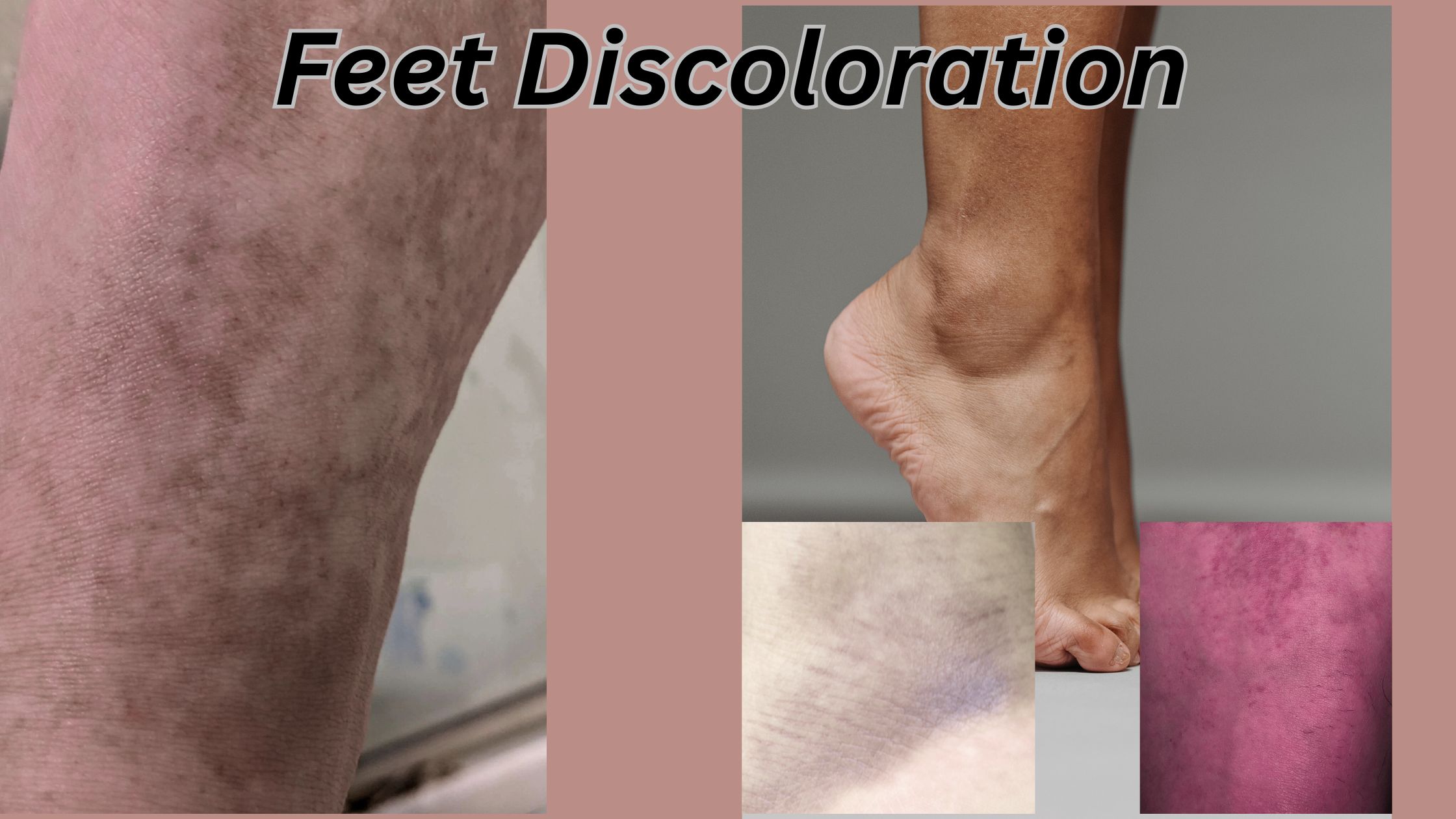 Feet Discoloration