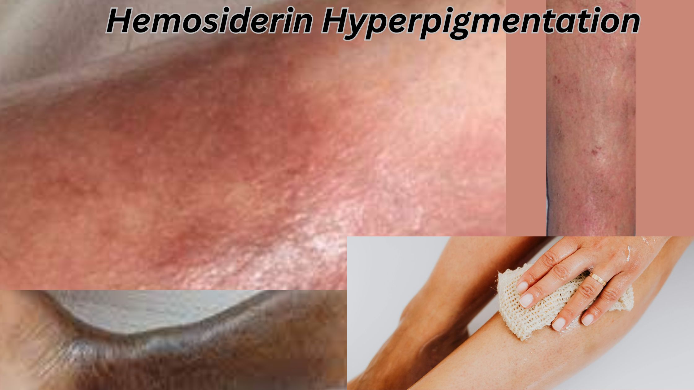 Hemosiderin hyperpigmentation