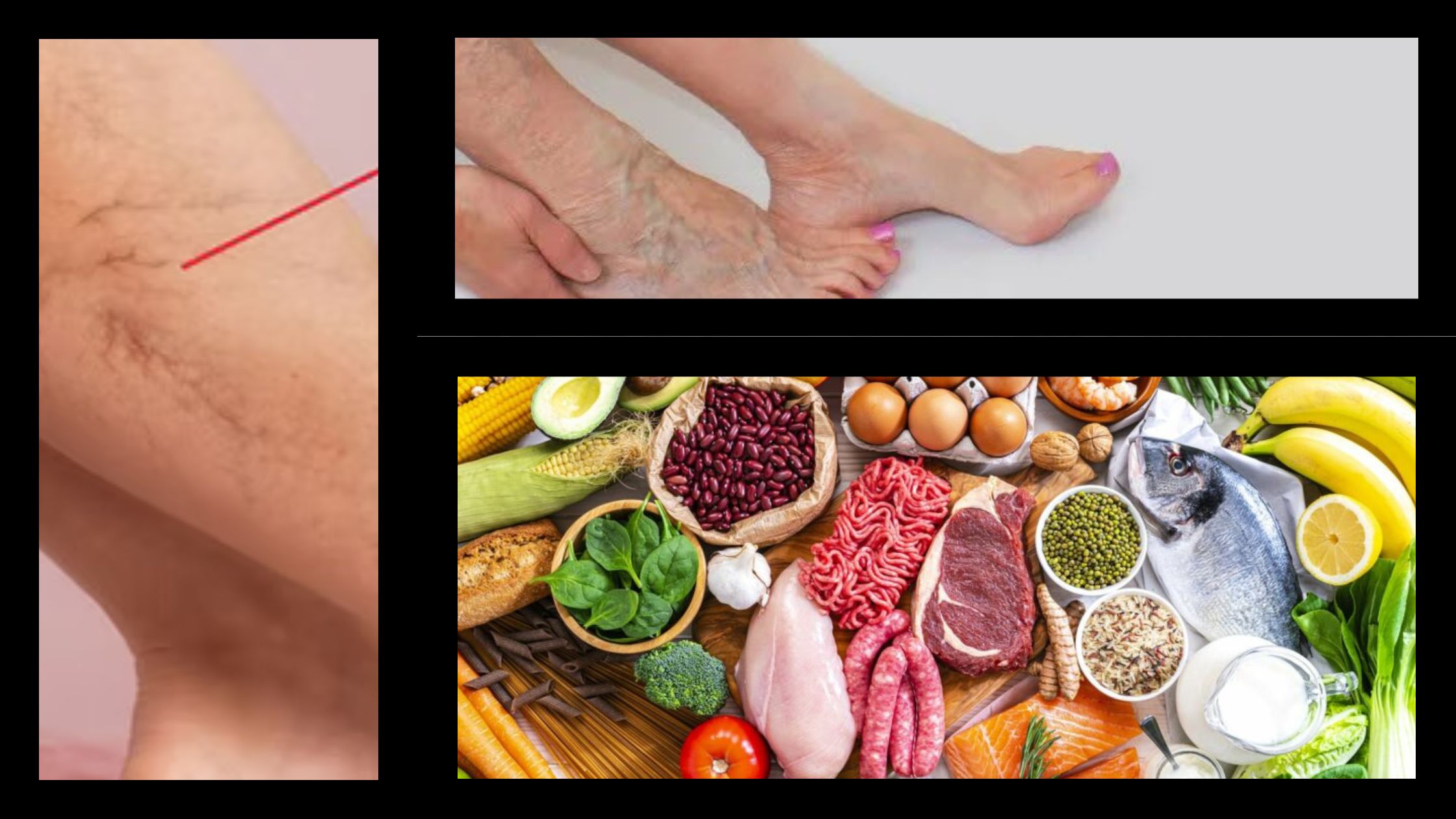 Natural Remedies to Treat Varicose Veins