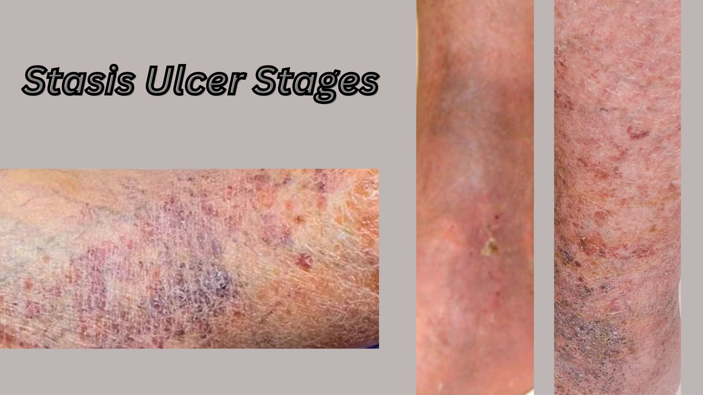 Stasis Ulcer Stages