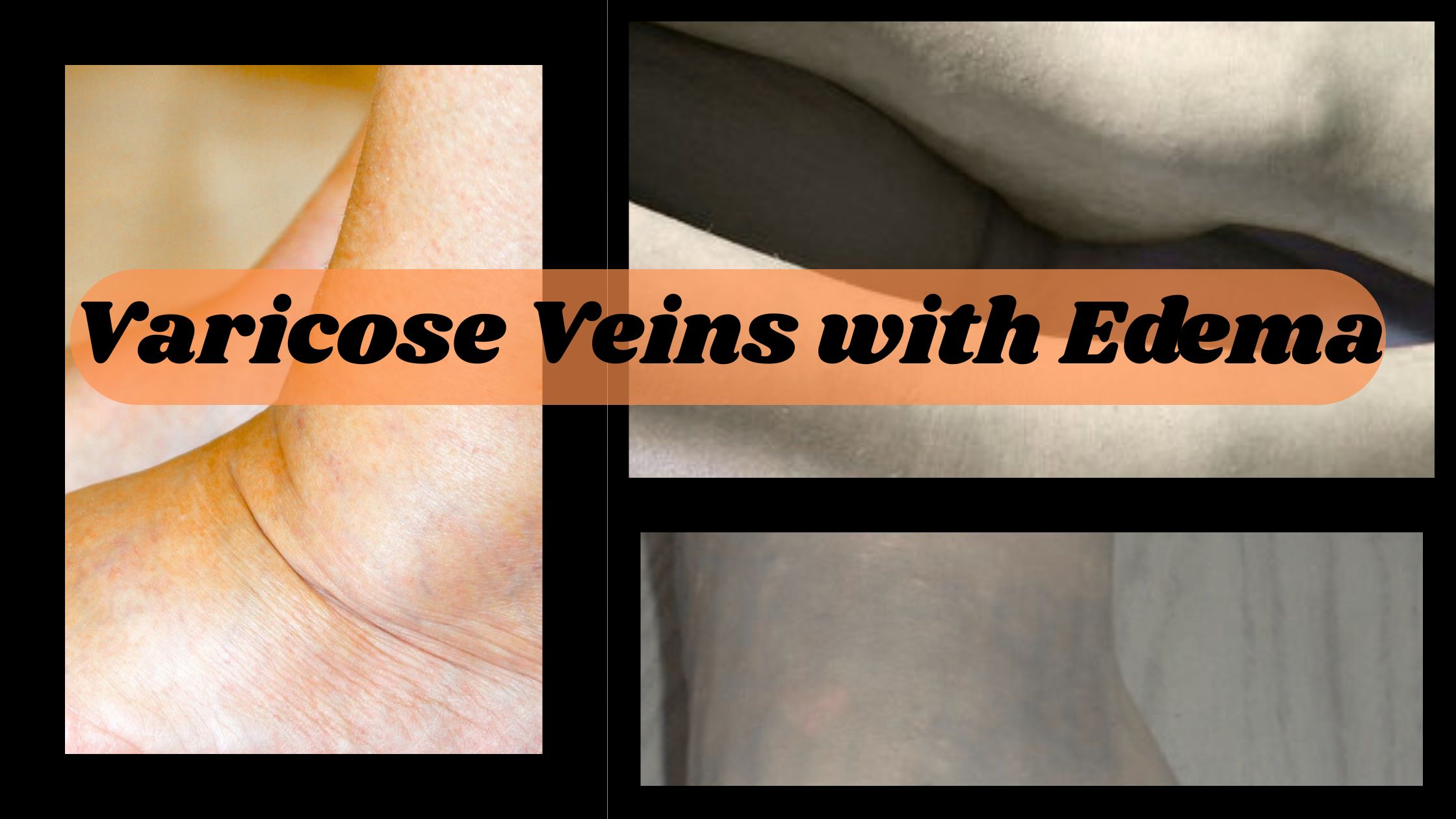 Varicose Veins with Edema
