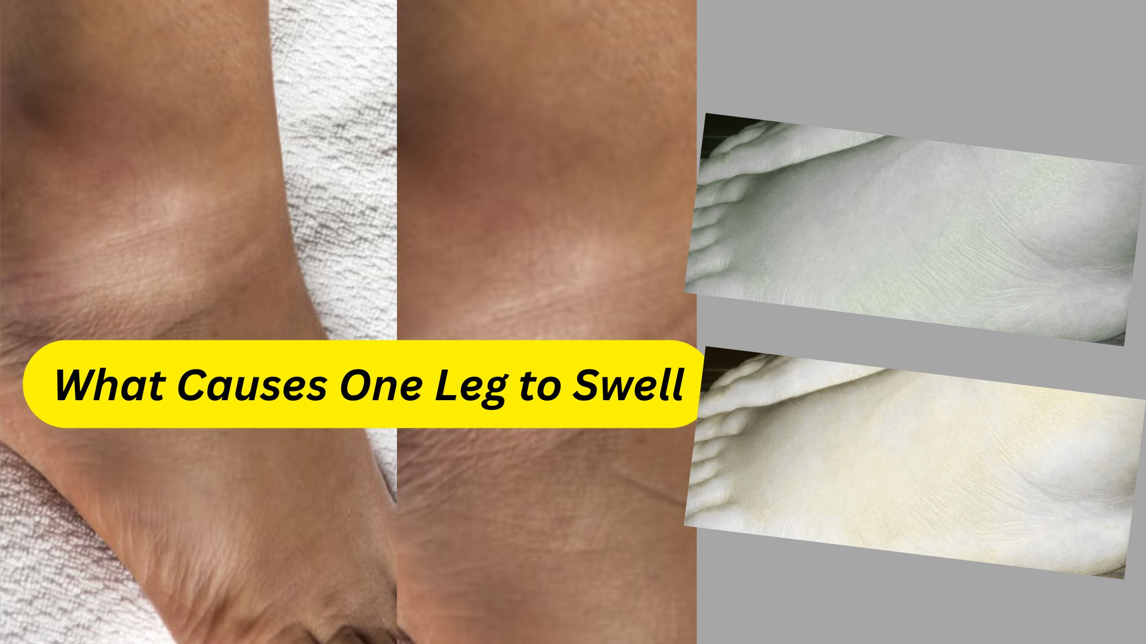 What Causes One Leg to Swell