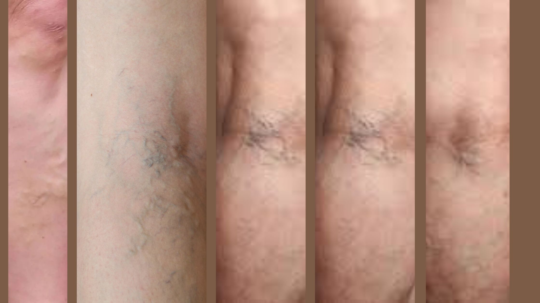 Why Do Varicose Veins Form