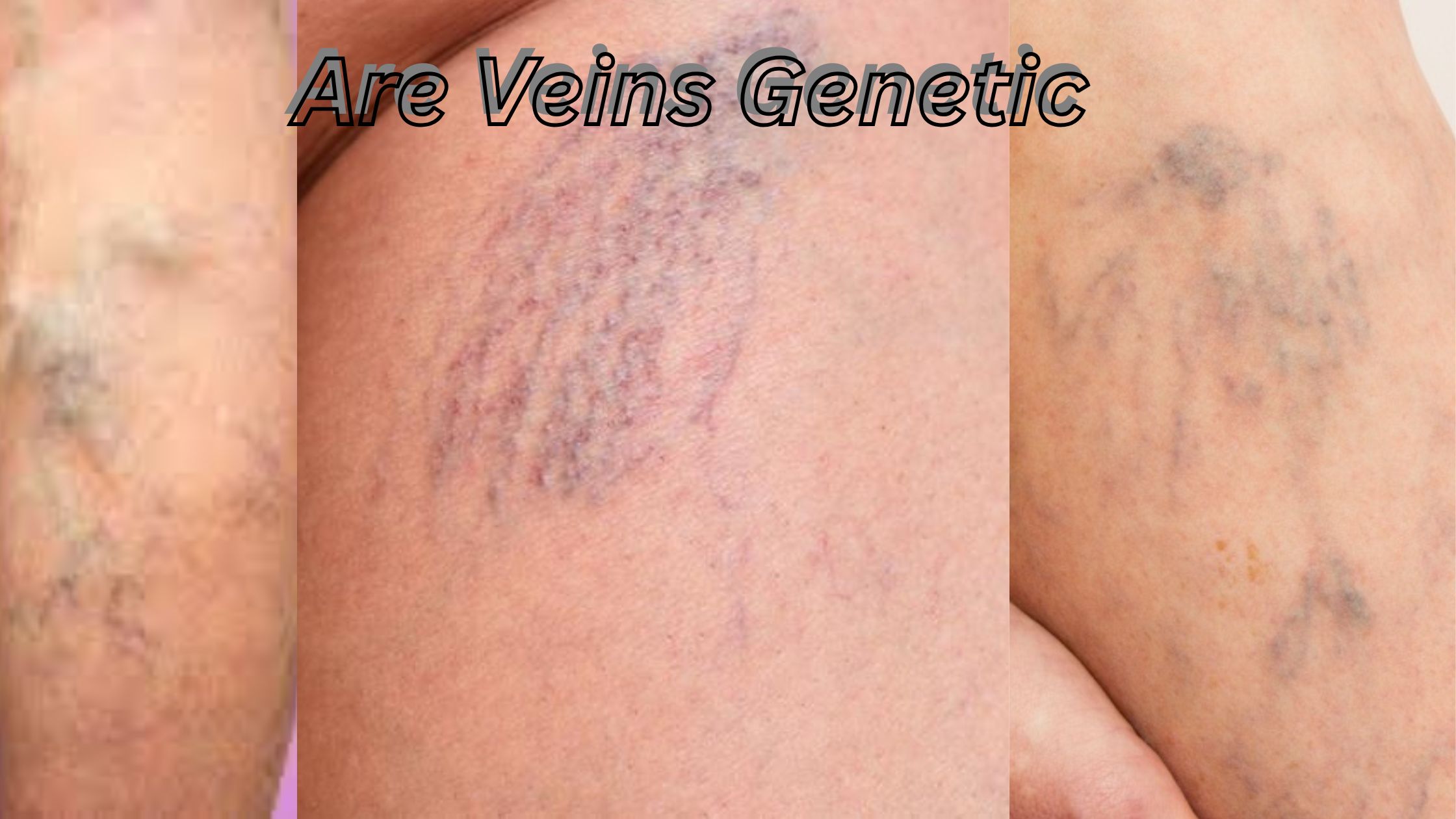 Are Veins Genetic