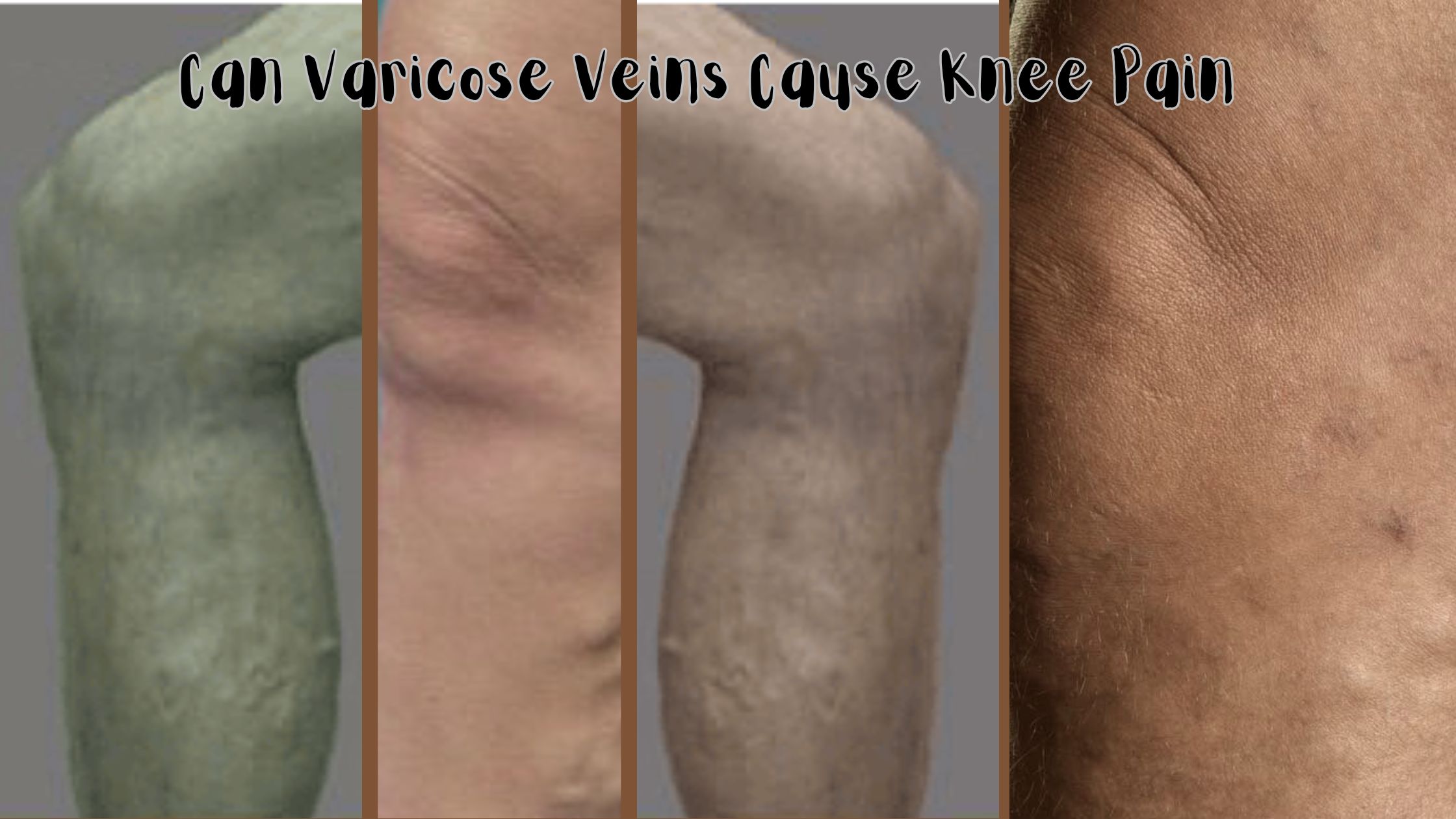 Can Varicose Veins Cause Knee Pain