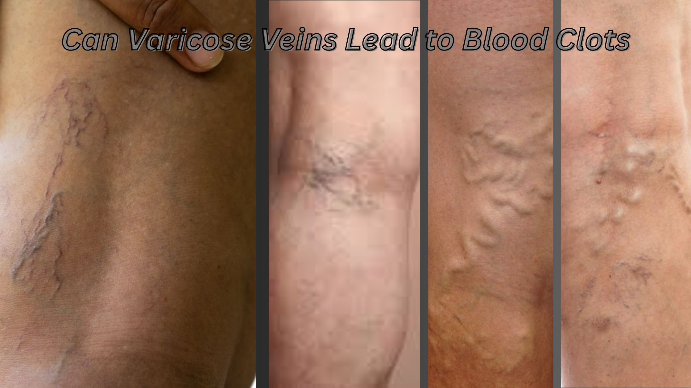 Can Varicose Veins Lead to Blood Clots