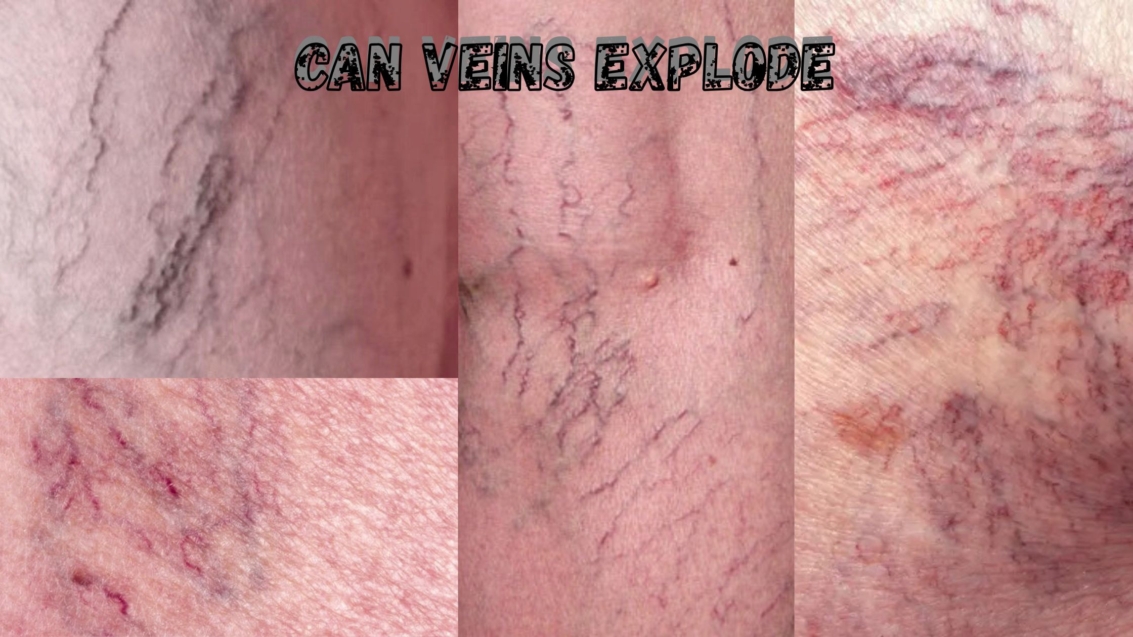 Can Veins Explode