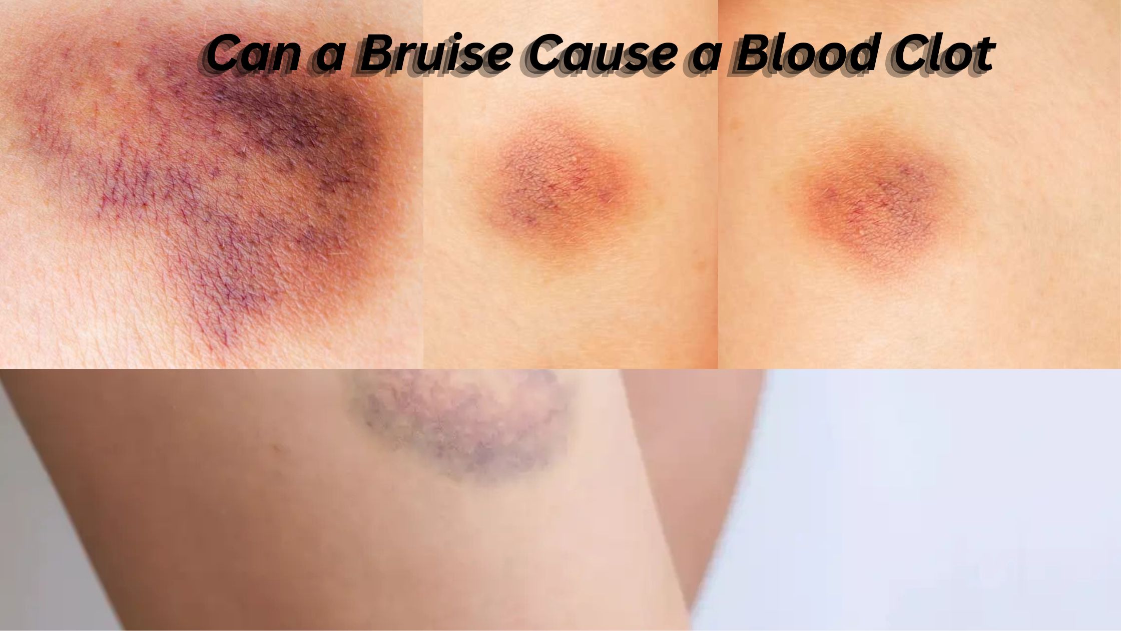 Can a Bruise Cause a Blood Clot