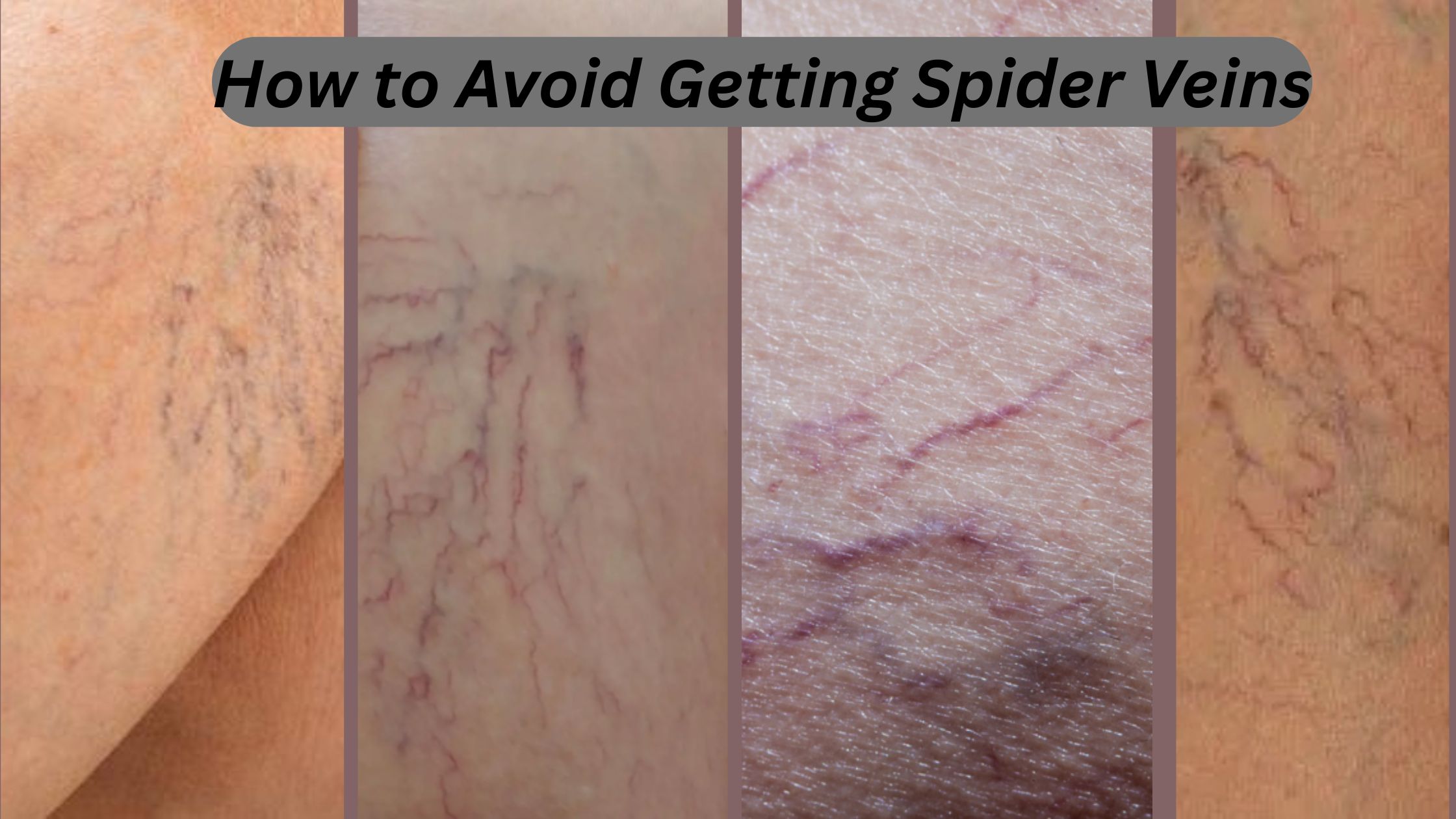 How to Avoid Getting Spider Veins
