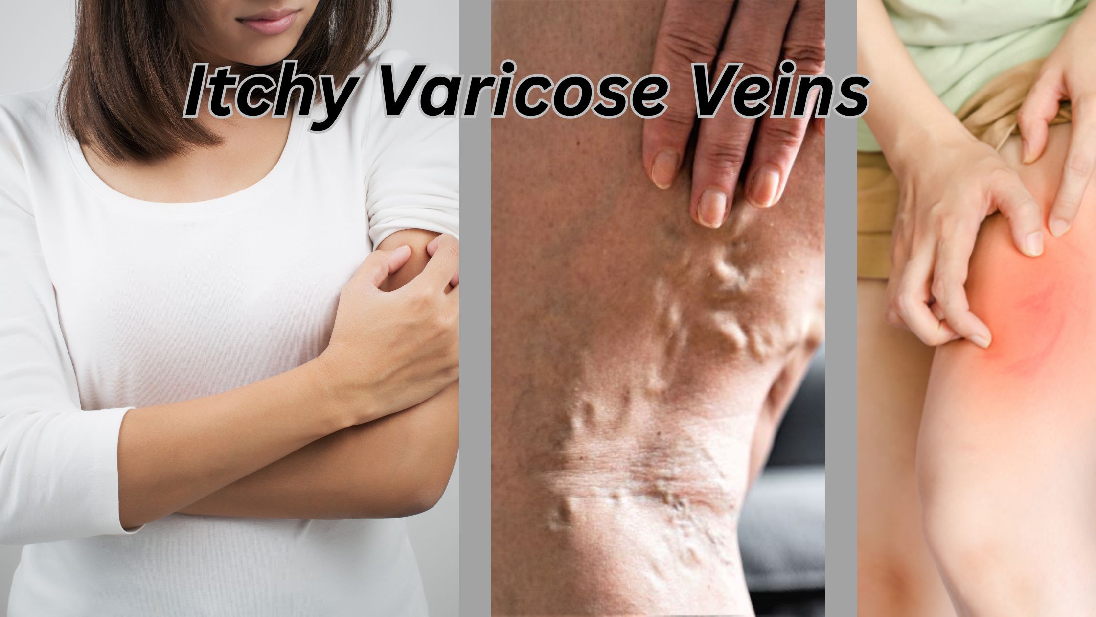 Itchy Varicose Veins