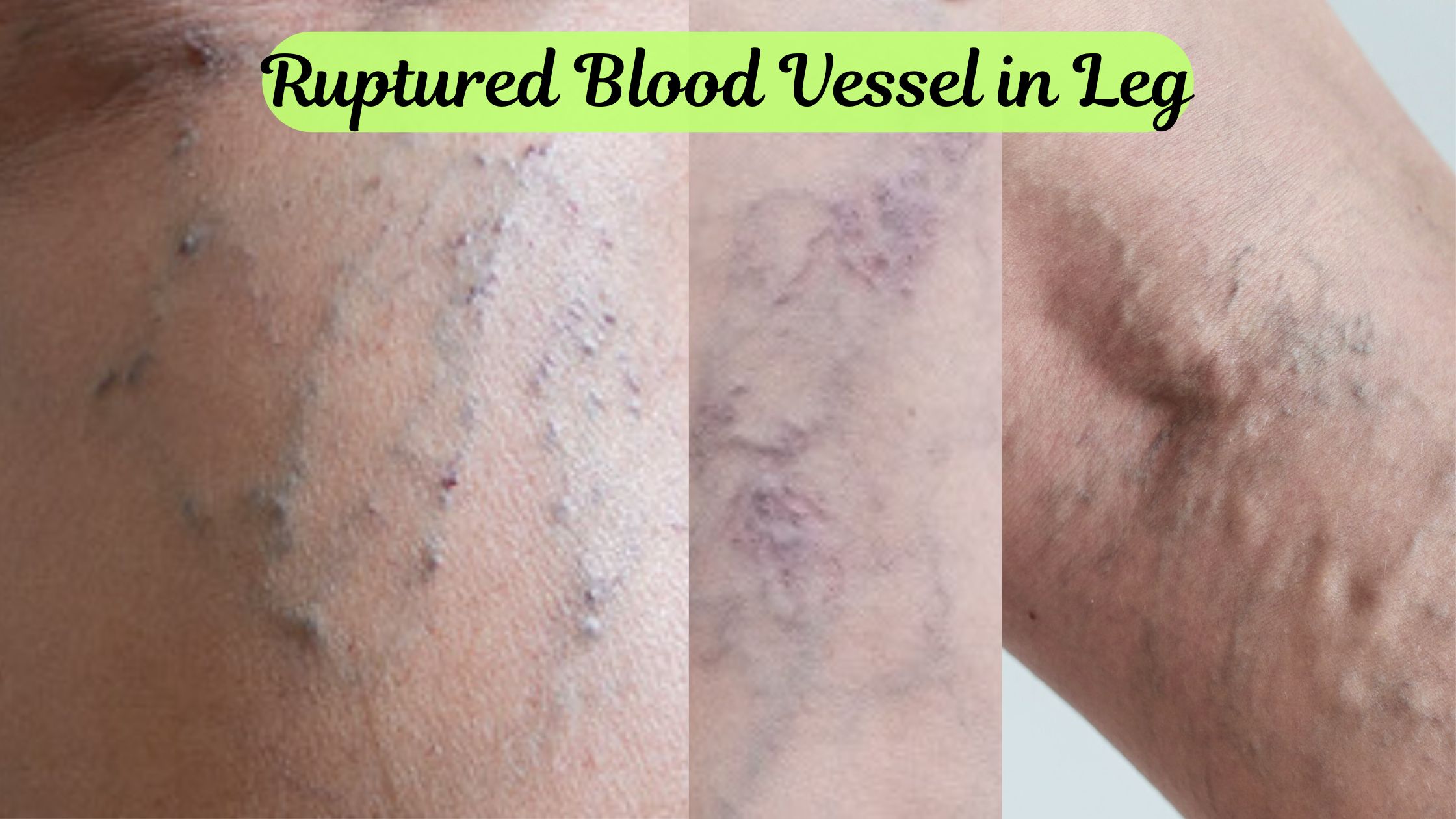 Ruptured Blood Vessel in Leg