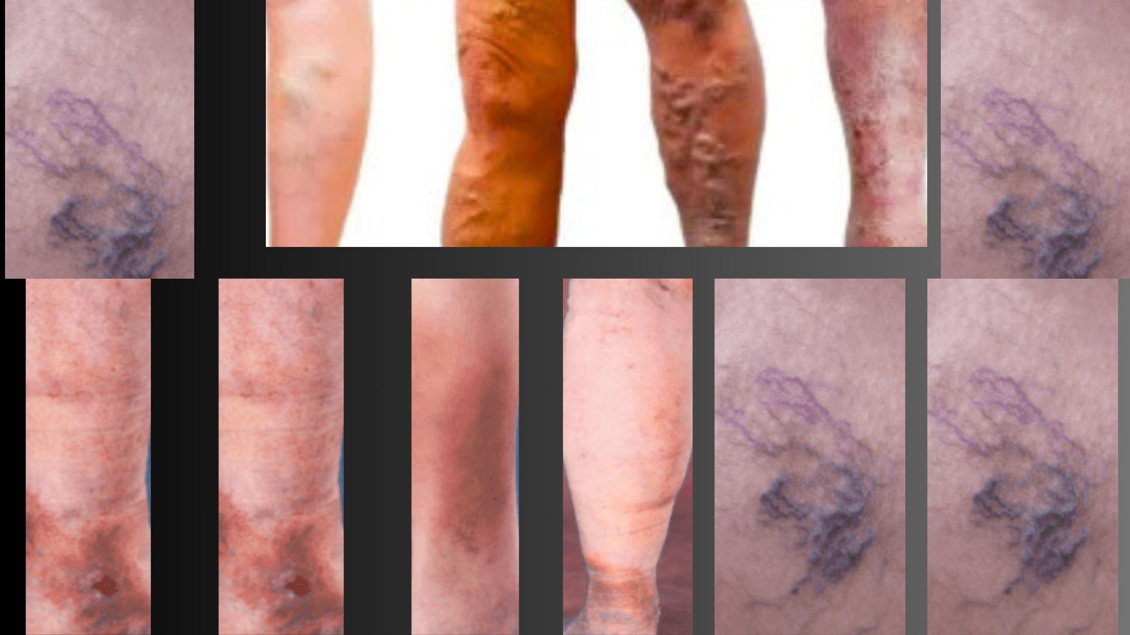 Stages of Venous Stasis Ulcers