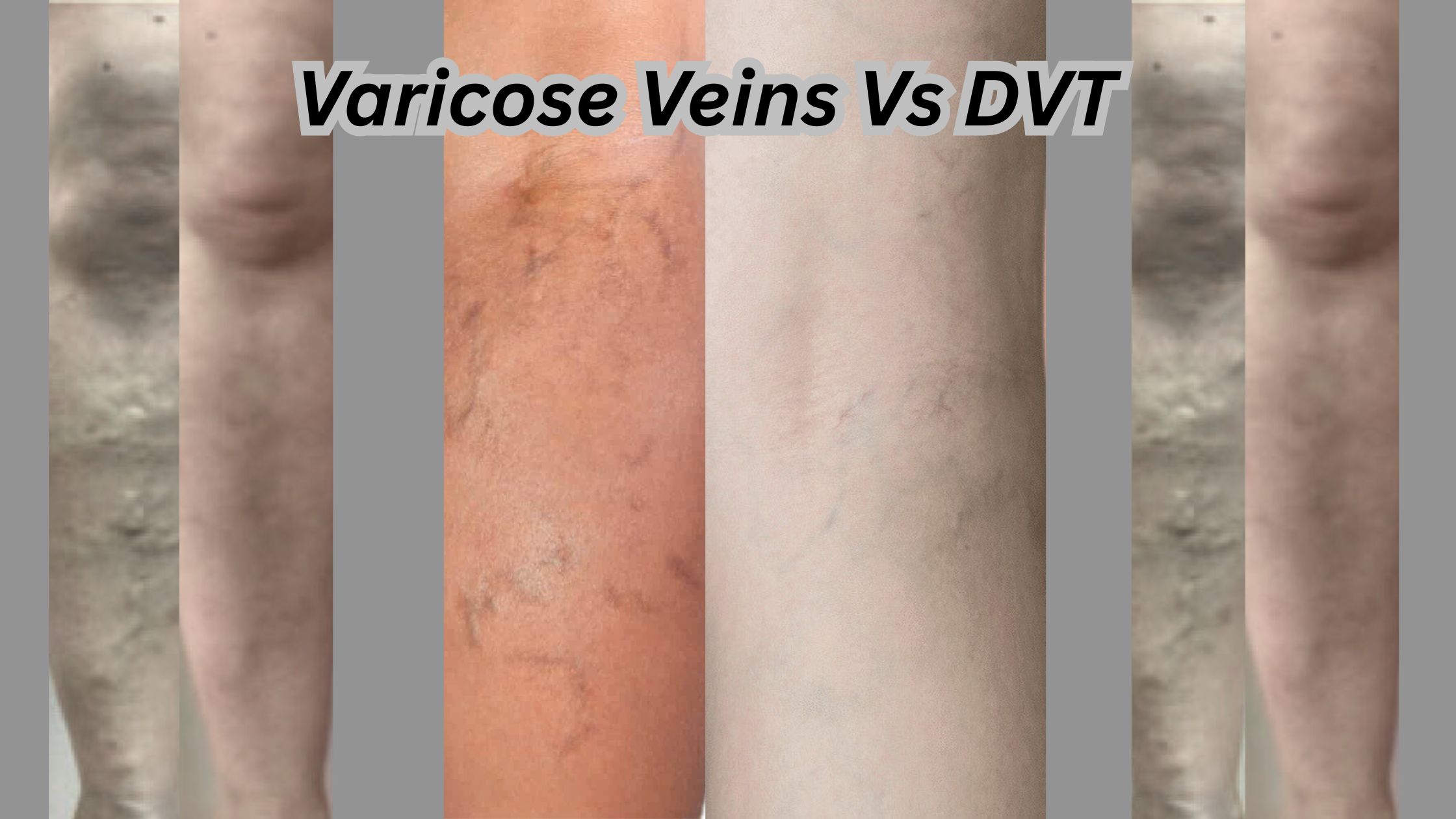 Varicose Veins vs DVT