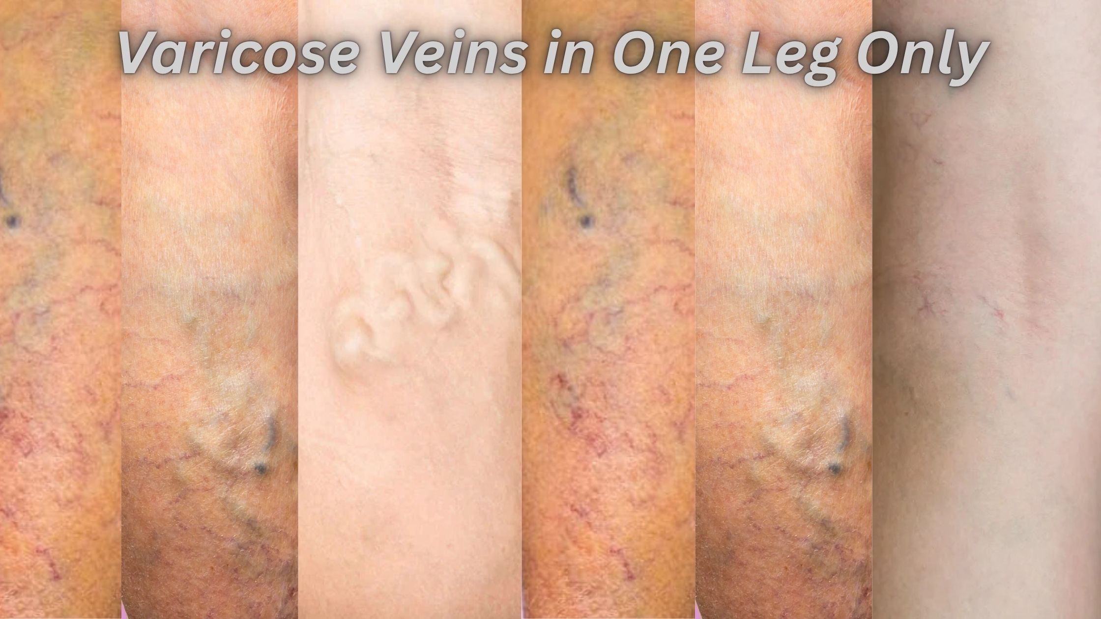 Varicose Veins in One Leg Only